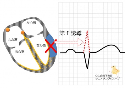 第Ⅰ誘導_R波がない.jpg