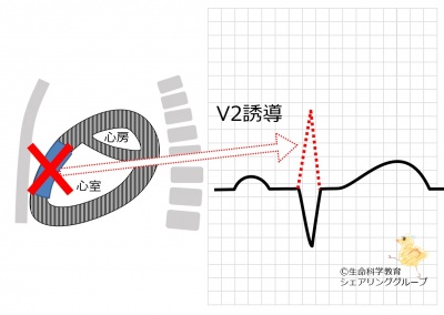V2誘導_R波がない.jpg