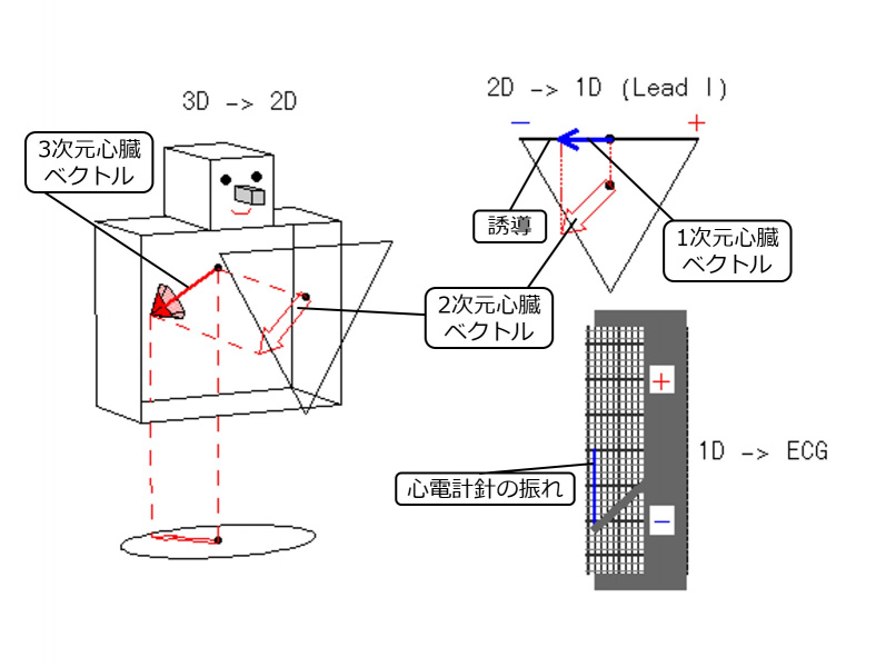 ファイル:ECGRtLPost3Dto1D.jpg