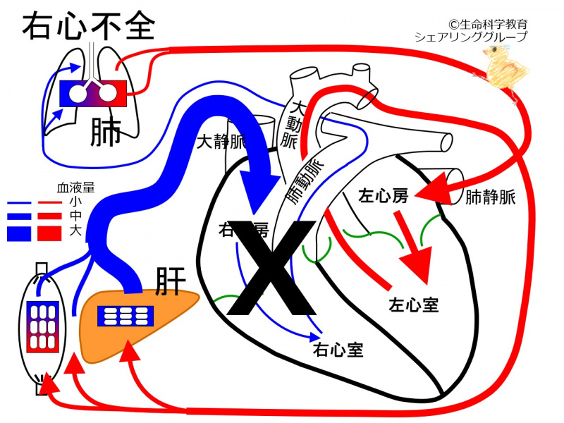 ファイル:RtVentInsufficiencyCongestion.jpg