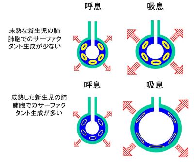 /wiki/images/thumb/1/1b/%E6%96%B0%E7%94%9F%E5%85%90%E8%82%BA.jpg/400px-%E6%96%B0%E7%94%9F%E5%85%90%E8%82%BA.jpg