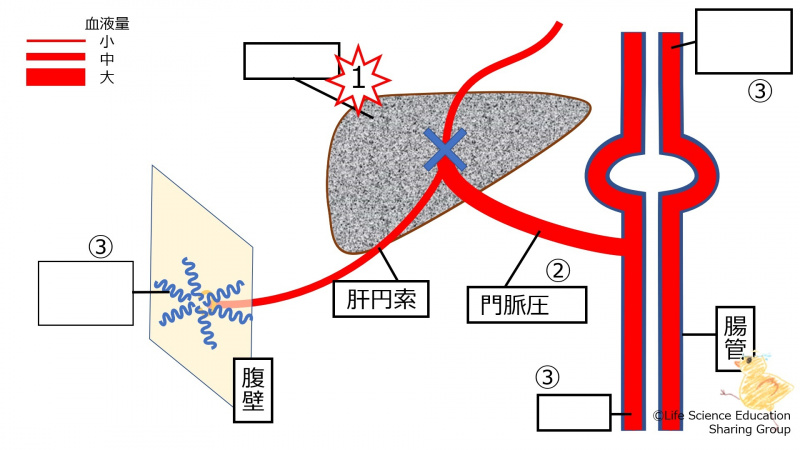 ファイル:PortalHypertensionLiverCirrhosis-wb.jpg