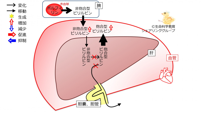 ファイル:BilirubinLiverFailure.jpg