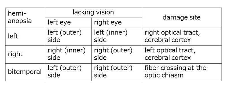 ファイル:Hemianopsia.jpg