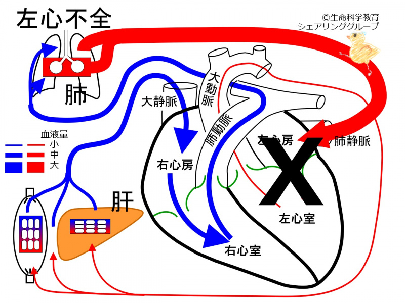 ファイル:LtVentInsufficiencyCongestion.jpg