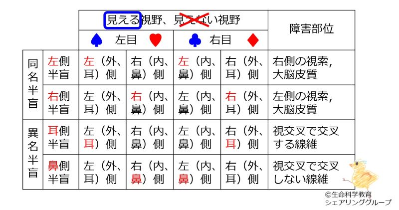 ファイル:HemianopsiaSummary-wb.jpg