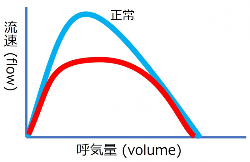 ファイル:FlowVolumeQuiz2.jpg