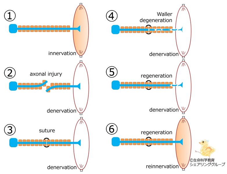 ファイル:Axonal injury.jpg