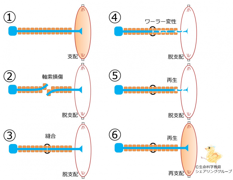 ファイル:Axonal injury ja.jpg