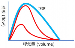 /wiki/images/thumb/b/bb/FlowVolumeQuiz3.jpg/250px-FlowVolumeQuiz3.jpg