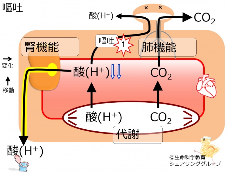 ファイル:Vomiting2metabolic-alkalosis.jpg